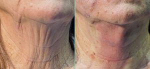 PDO Threads immediate results for sagging neck Threadlift: think skin scaffolding
