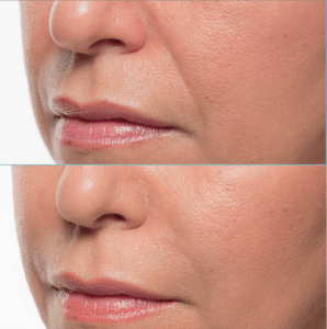 dermal fillers can erase lines and folds