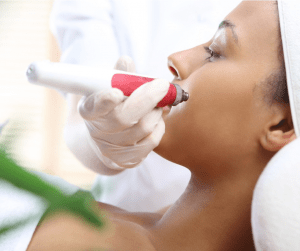 Medical microneedling for CIT - Collagen Induction Therapy