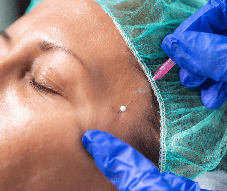 PDO Threads create scaffolding for tighter skin