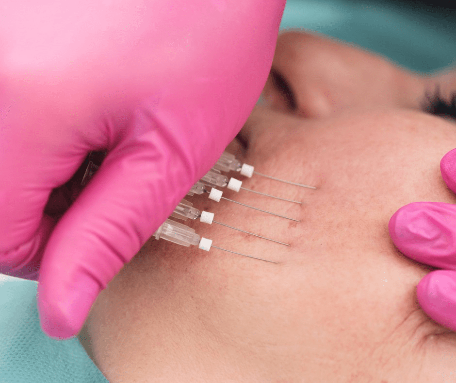 Watch the PDO thread lift by Dr. Nangrani