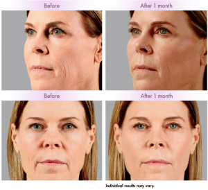 Voluma for cheek restoration