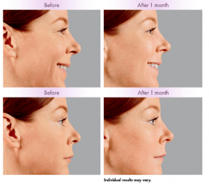 Profile balancing