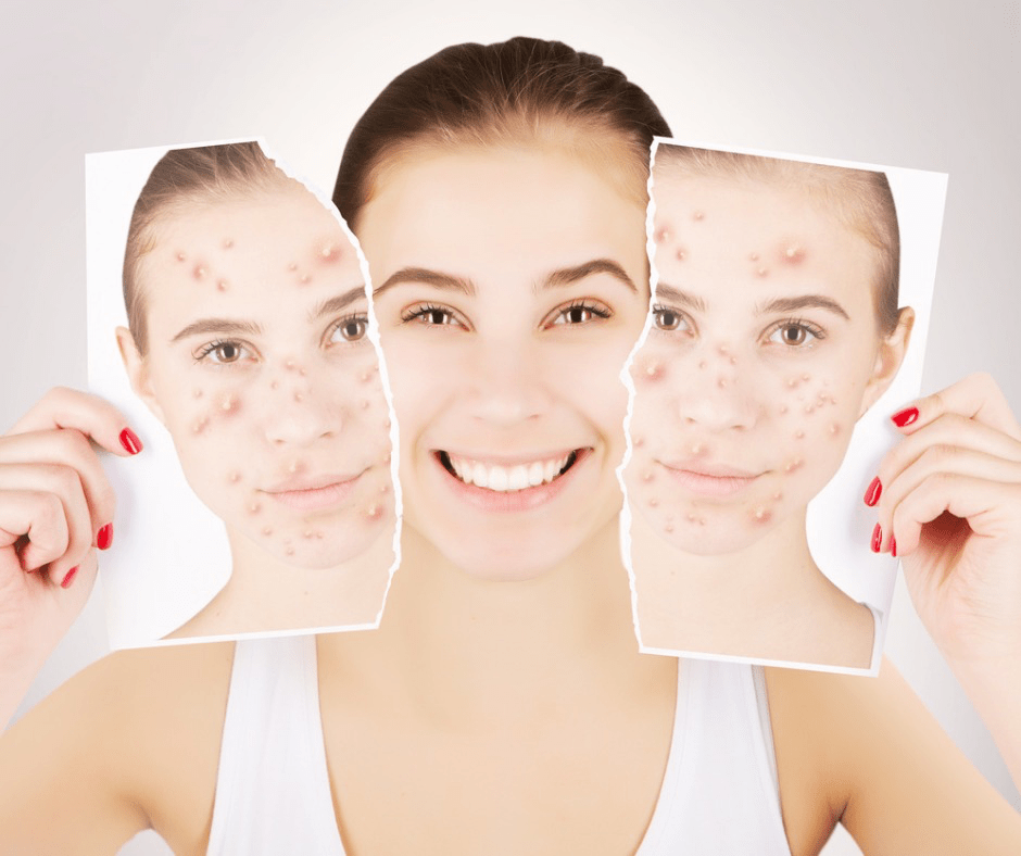 microneedling results