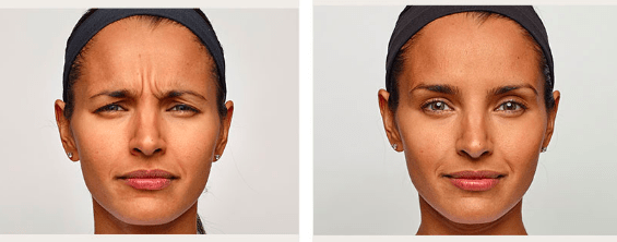 Botox Before & After Pic