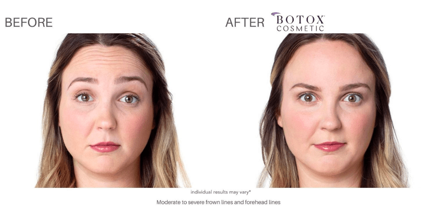 Botox questions