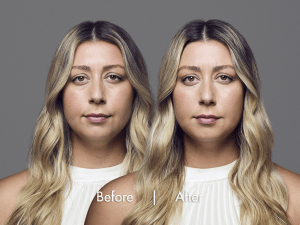 The RHA® (resilient hyaluronic acid) collection of fillers