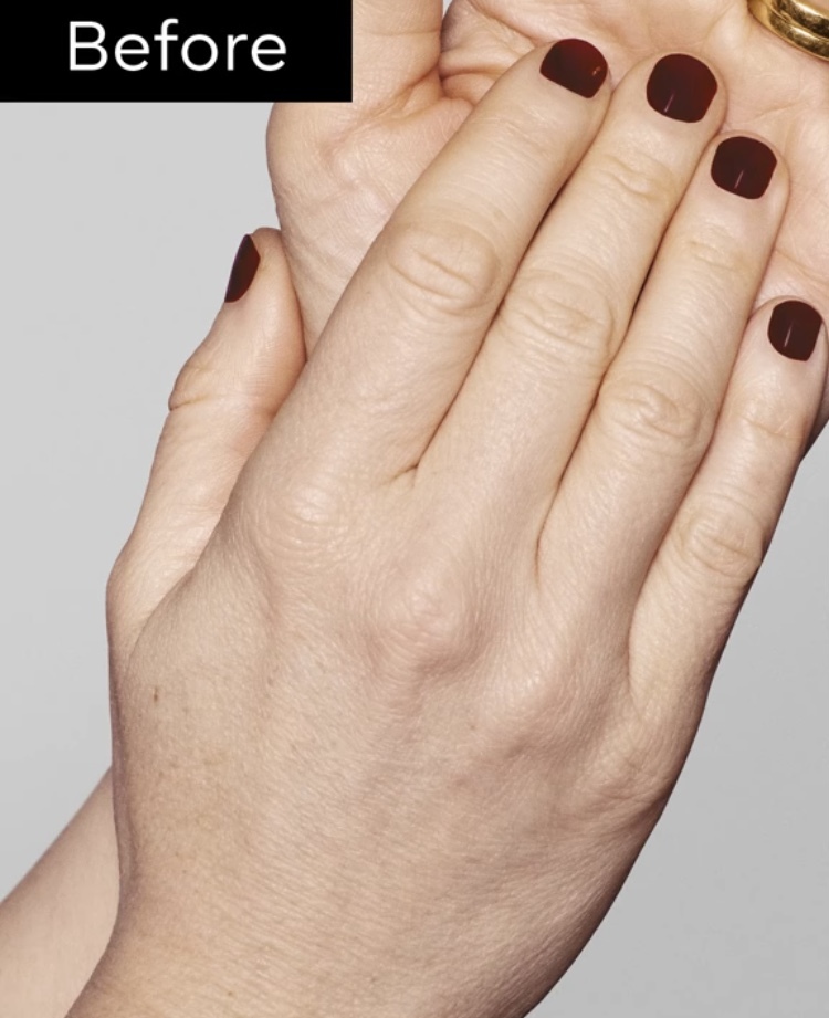 Hand Rejuvenation
