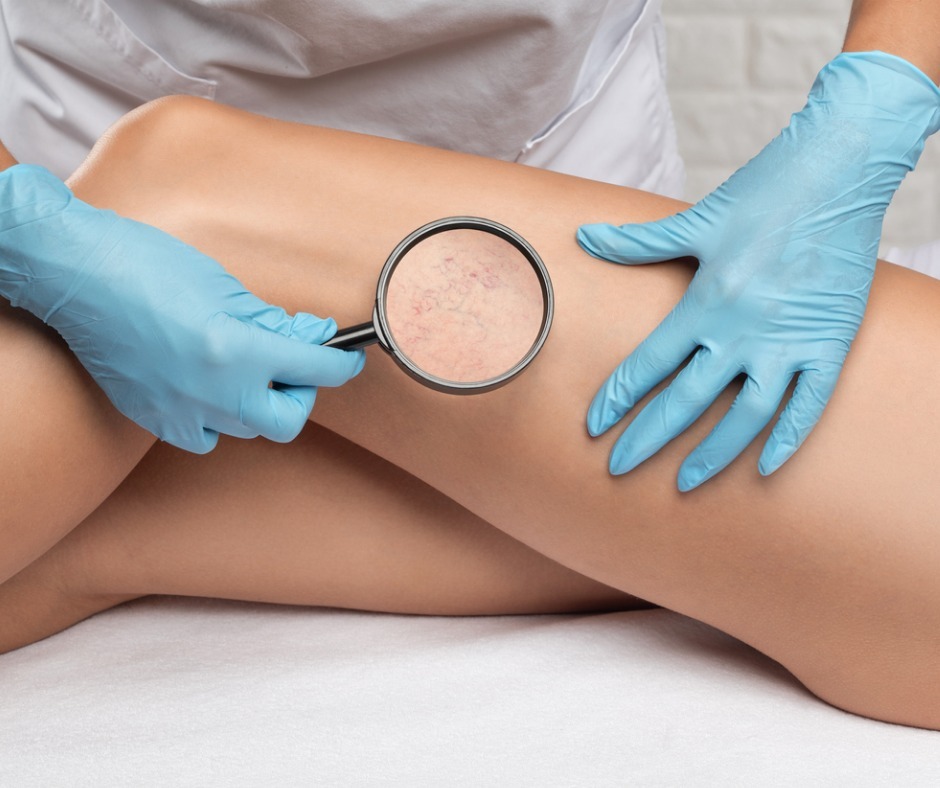 doctor-shows-the-dilation-of-small-blood-vessels-of-the-skin-on-the-picture-id1337654239