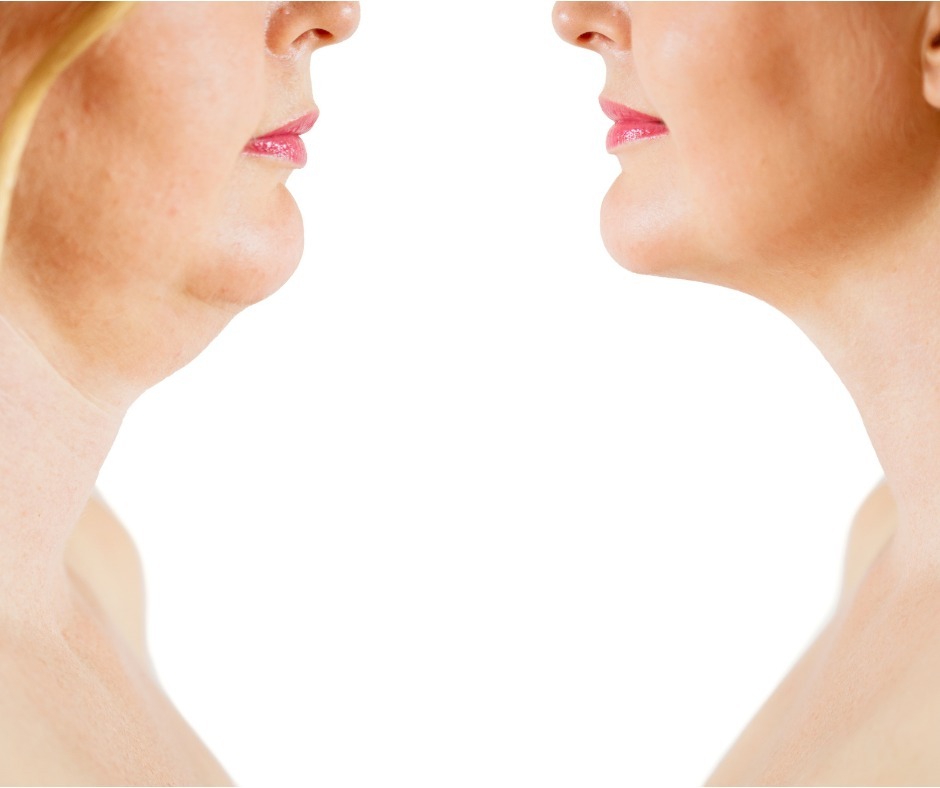 double-chin-fat-or-dewlap-correction-before-and-after-picture-id1136560148