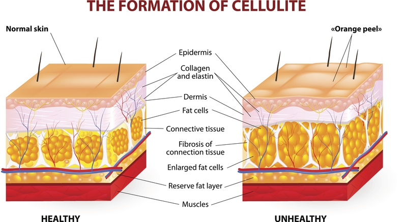 The formation of cellulite. Vector diagram