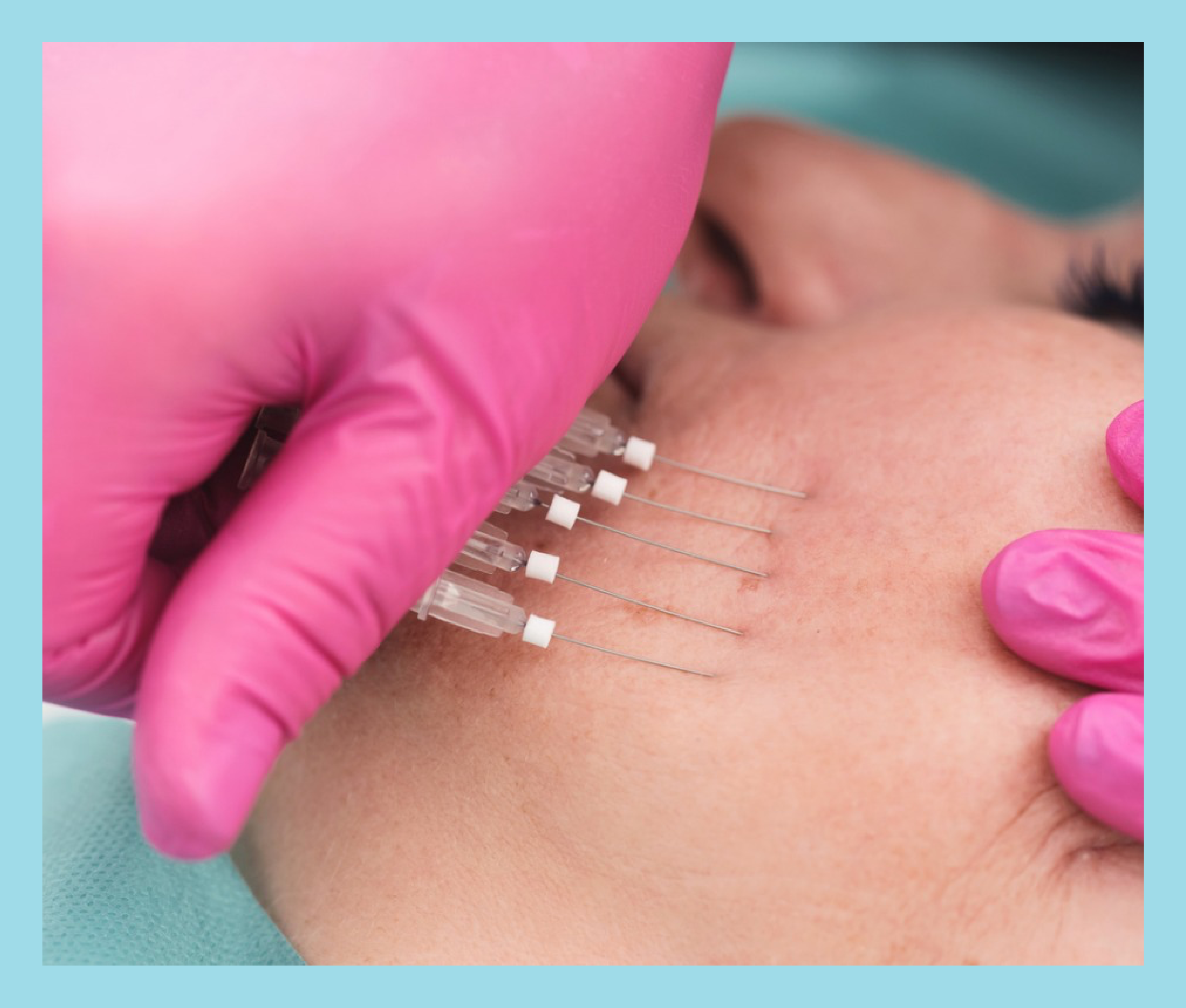 Body Contouring with PDO threads