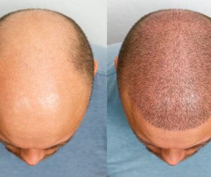 Hair restoration before and after Vedas Medical Spa & Wellness Center