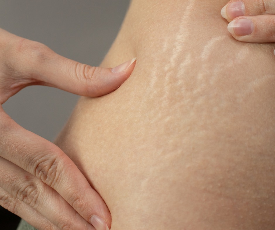 young-woman-showing-stretch-marks-on-her-body-picture-id1300473170