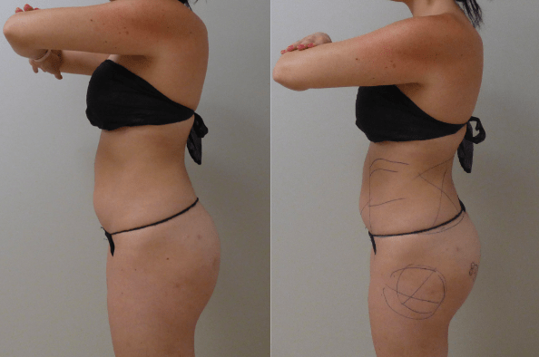 SmartLipo happy clients
