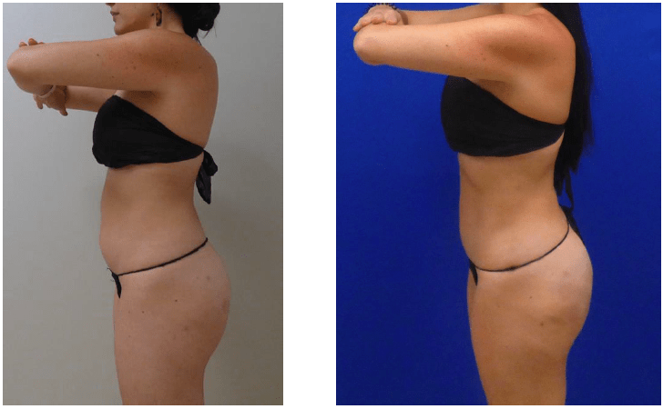 SmartLipo happy clients