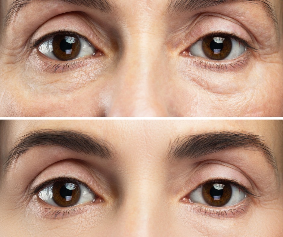 Under-eye bag removal