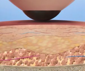 less treatment with better results