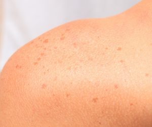 Sunspots on female shoulder