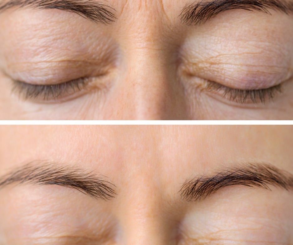 Happy Hour Botox