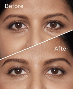Hollow eye area