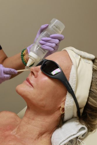 Intense Pulsed Light (IPL)