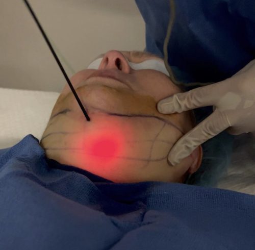 Smartlipo chin at Vedas Medical Spa & Wellness Center