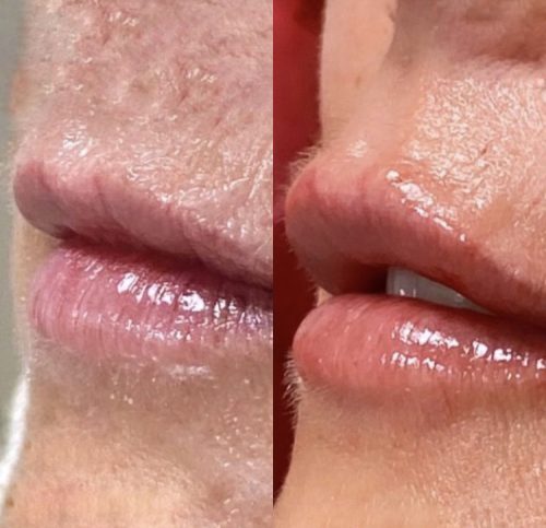 Lip filler