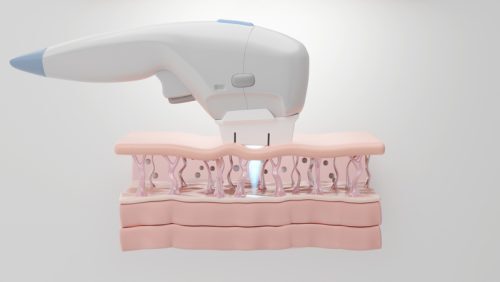 Ultherapy device- Vedas Medical Spa & Wellness Center