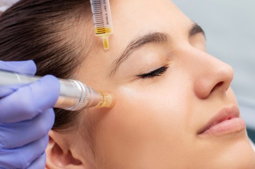 Image of a woman having a microneedling treatment by a professional- Vedas Medical Spa & Wellness Center