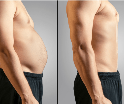 Image shows a before and after Smartlipo image of a man with a large stomach and then a flatter stomach- Vedas Medical Spa & Wellness Center