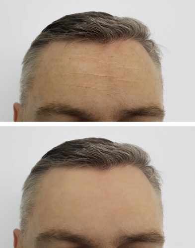 Man wrinkles before and after forehead Botox- Vedas Medical Spa & Wellness Center