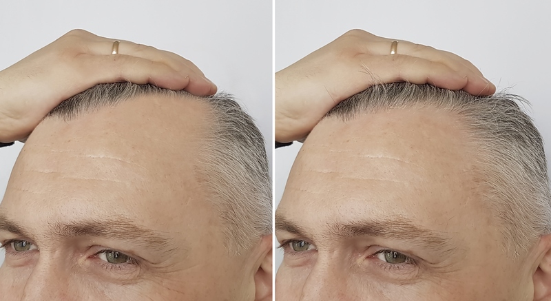 male baldness before and after