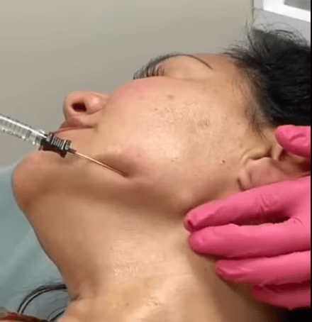 Facelift