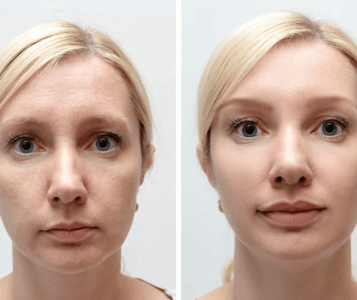 botox1
