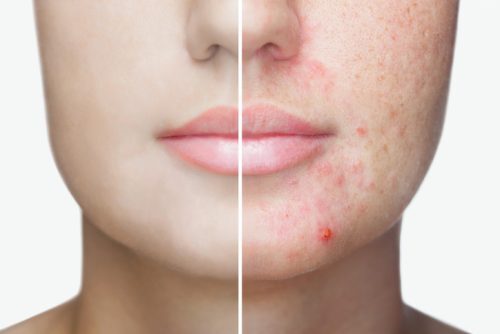 A young girl with a problem skin. Photo before and after treatment for acne.