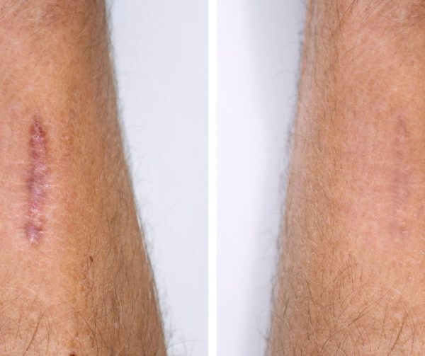 result-after-procedure-of-scar-removing-scar-surgery-or-laser-removal-picture-id1302961373-1-600x503