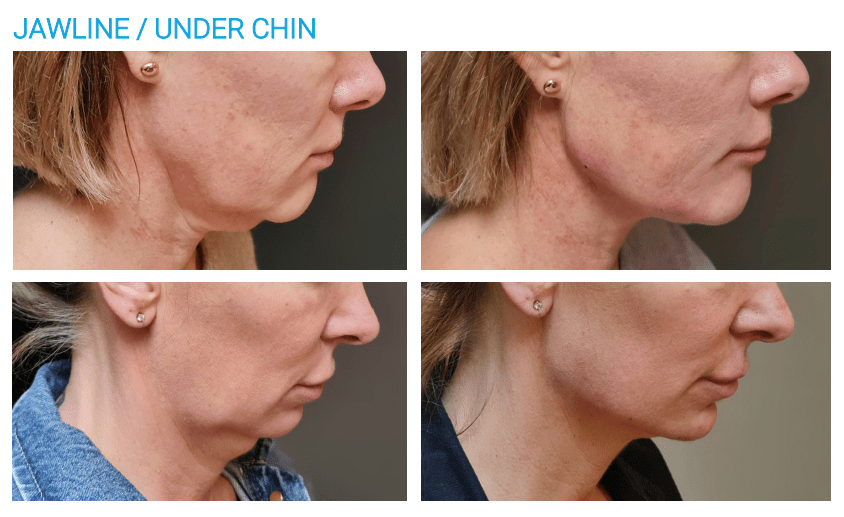 before and after endolift