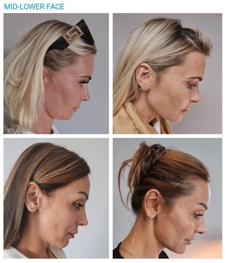 endolift mid lower face