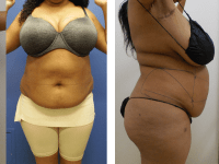 BEFORE SL (01/28/19) AND AFTER (02/14/19) SmartLipo