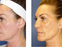 Before and after fillers and Y-LIFT Y-LIFT and fillers