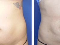 SmartLipo Before 3-29-19 & After 4-17-19 Reshape with SmartLipo