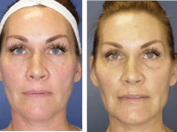 Before fillers 10-22-19 and after 10-23-19, Y-LIFT Before fillers 10-22-19 and after 10-23-19