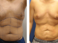SmartLipo - Abs