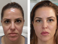 Before fillers 10/19/18 and after 10/26/18 Voluma Before and After