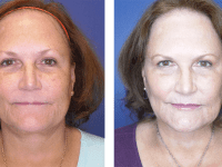 Y LIFT Before and After
4 days post-procedure Y LIFT