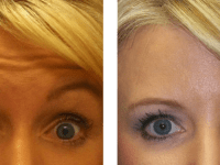 Botox gets you party ready