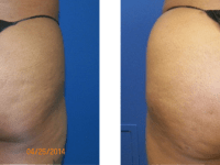 Fat Transfer