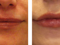 Juvederm gives dermal filler advantages over surgery Juvederm lip augmentation