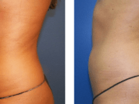 Smart Lipo - Abs